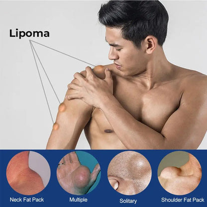 LOT Lipoma Ointment Effectively Removal Lipoma Fibroids Cream Body Cream Dissolving Fat Easy To Use Herbal Lipoma Removal Cream